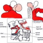 Current Headrest Design and Whiplash Injury