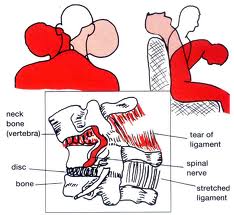 Current Headrest Design and Whiplash Injury